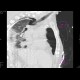 Nasogastric tube in pleural cavity, pneumothorax, pleural effusion: CT - Computed tomography